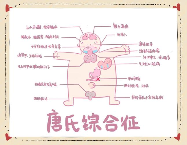唐氏症可以活到幾歲
