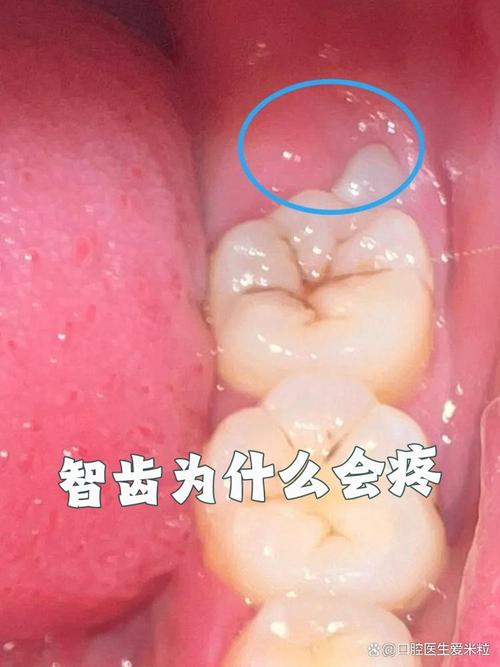 智齒的洞多久長回來