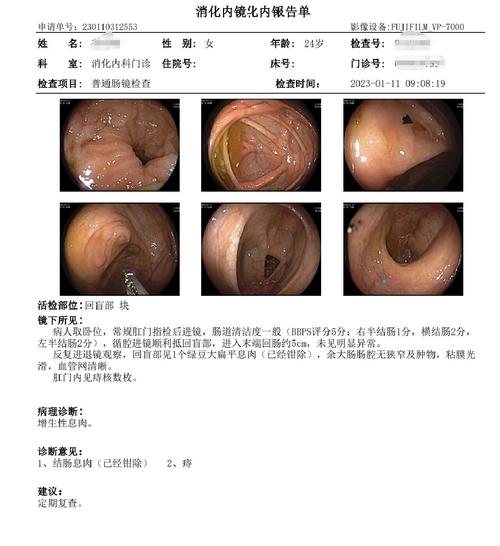 大腸鏡如何轉彎