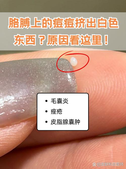 痘痘貼吸出來白白的是什麼