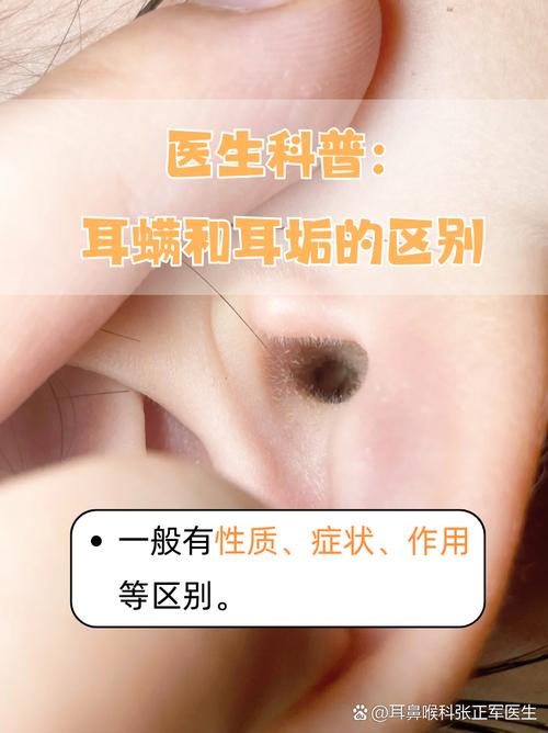 為什麼會有耳疥蟲?揪出隱藏的敵人,預防與治療全攻略 3 為什麼會有耳疥蟲