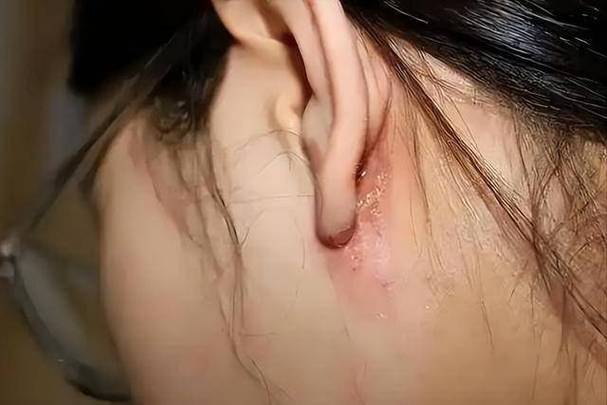 過敏嚴重會死嗎?深入解析過敏反應的致死風險與應對之道 1 過敏嚴重會死嗎