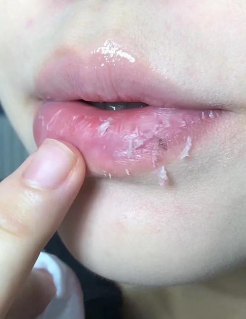 嘴唇乾是糖尿病嗎
