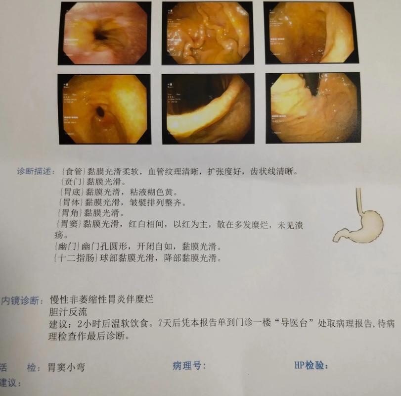 十二指腸潰瘍會痊癒嗎