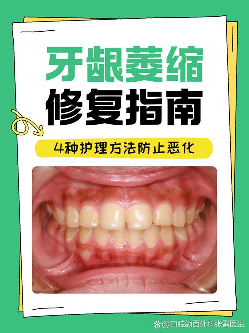 怎麼知道自己牙齦萎縮?牙醫教你自我檢測,掌握牙周健康的關鍵訊號! 1 怎麼知道自己牙齦萎縮