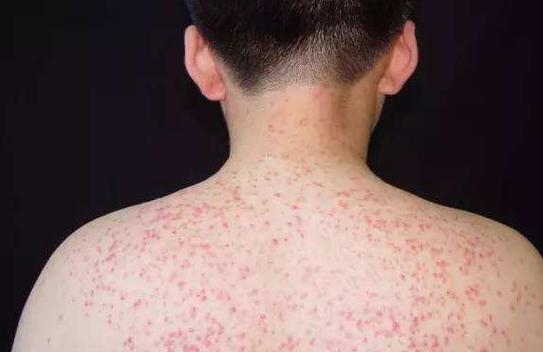 糖尿病皮膚症狀有哪些