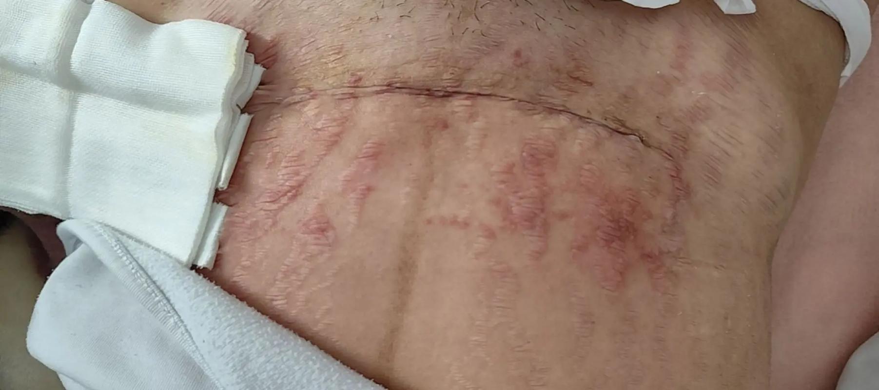 手術傷口多久不痛