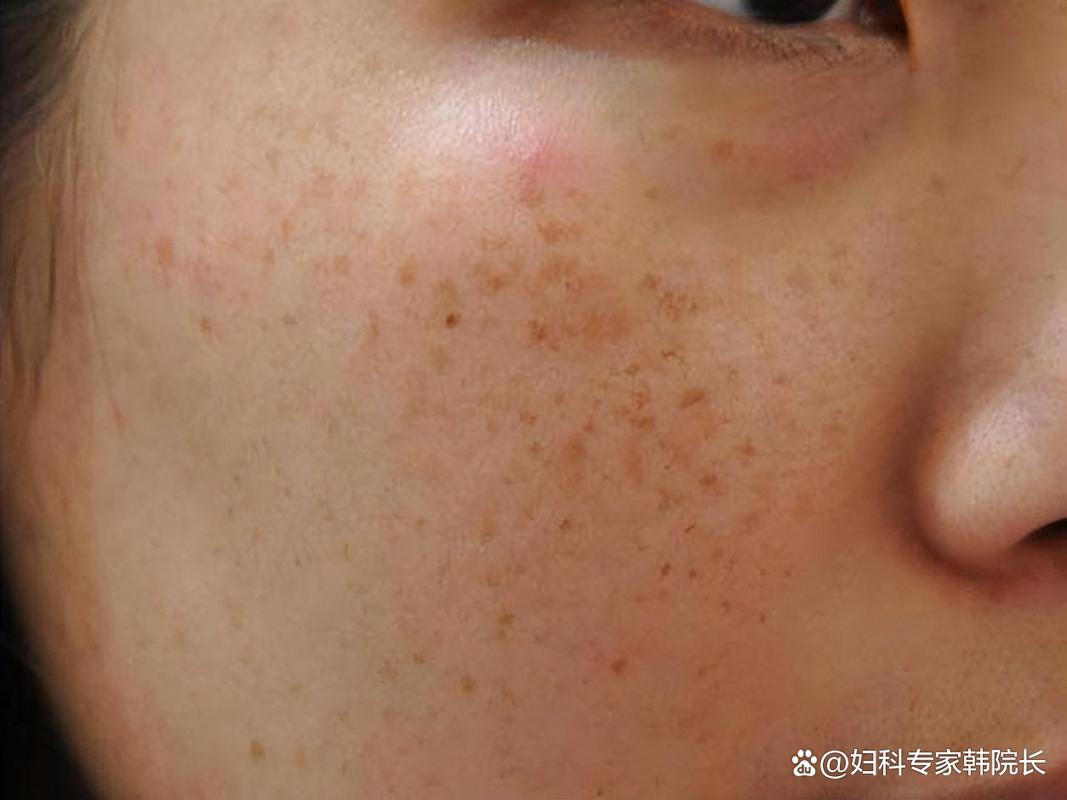 睡不好會長斑嗎?深度解析睡眠不足對肌膚的影響與改善對策 3 睡不好會長斑嗎