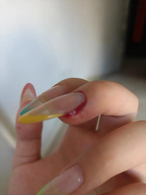 指甲掀起來一定要拔嗎