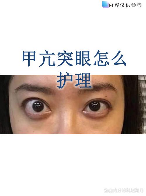 甲狀腺低下眼睛會凸嗎