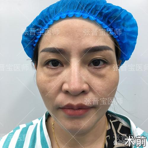 開刀可以熬夜嗎?術前術後打破迷思,掌握黃金恢復期關鍵! 1 開刀可以熬夜嗎