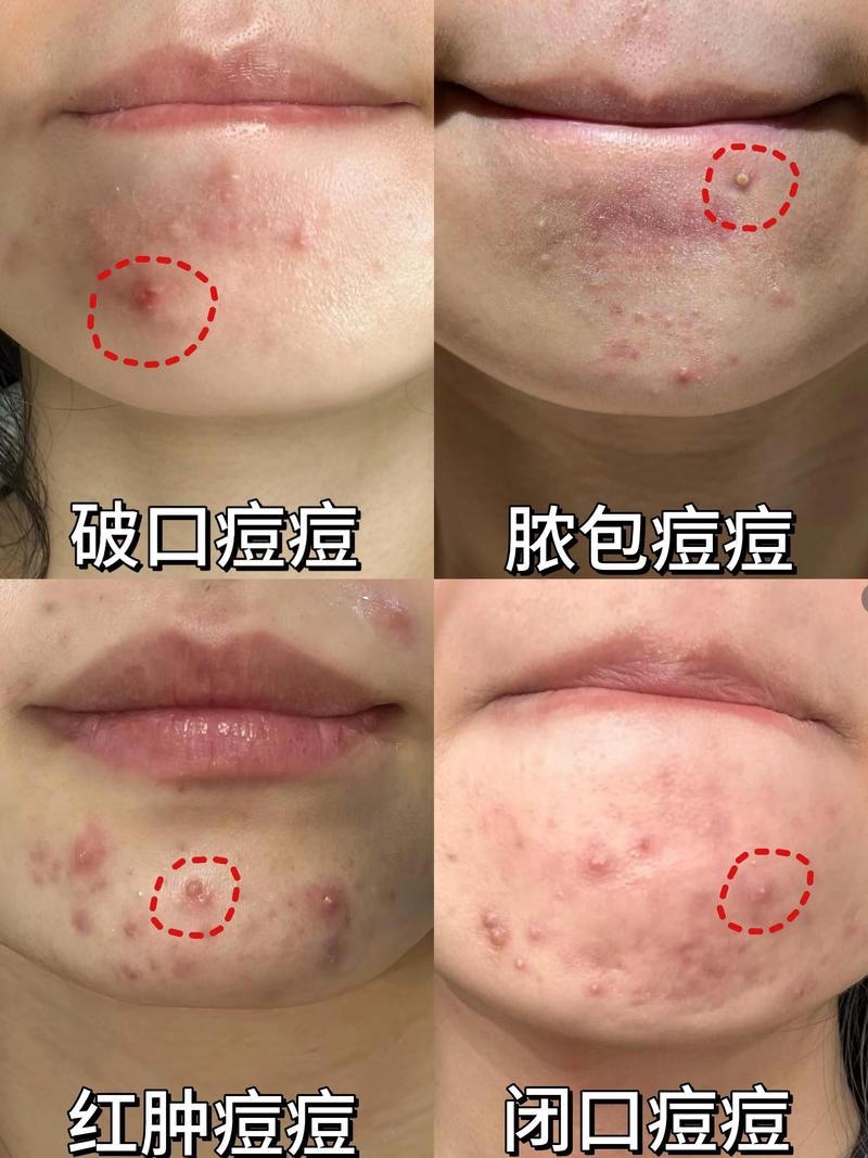 皮膚紅腫硬塊怎麼辦