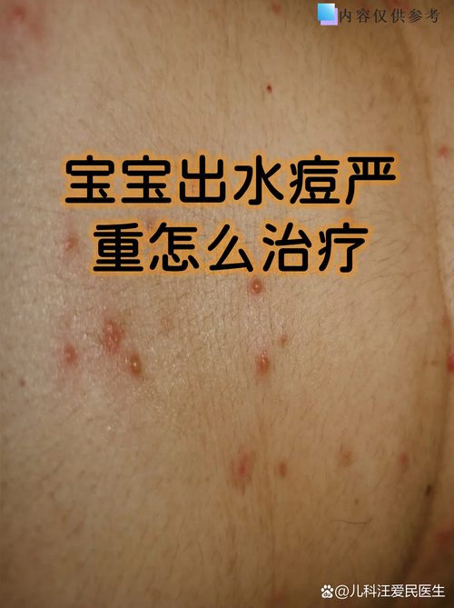 水痘得過會再得嗎
