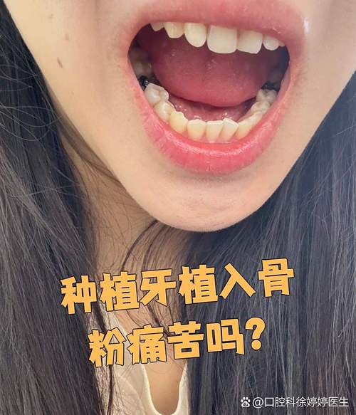 有人後悔植牙嗎
