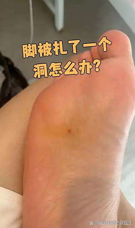 為什麼腳會有洞?從日常小傷到潛在疾病的深度解析 1 為什麼腳會有洞