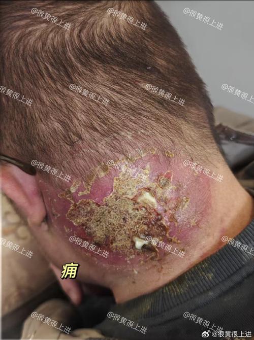 火疖子台灣叫什麼