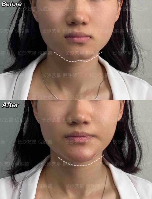 玻尿酸打下巴好嗎