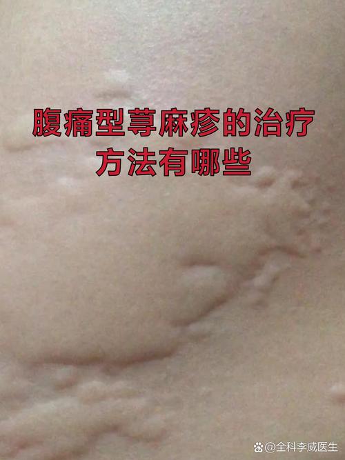 蓖麻油會過敏嗎