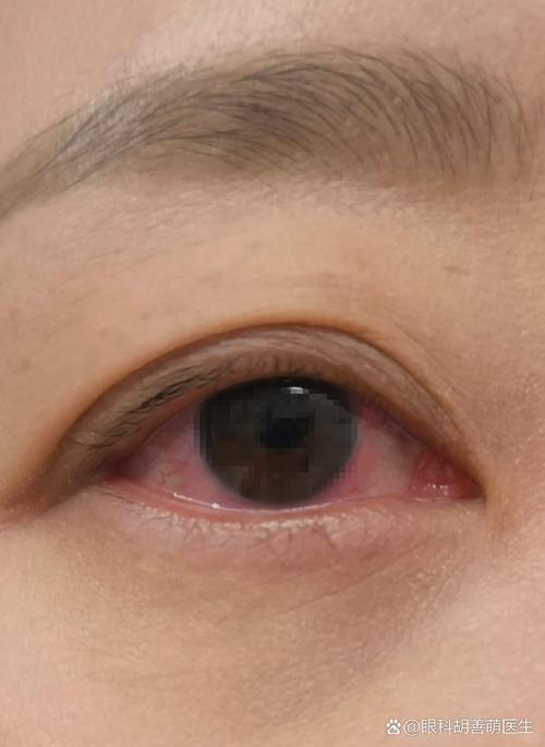 青光眼眼睛會紅嗎?釐清常見迷思,掌握眼部健康關鍵 1 青光眼眼睛會紅嗎