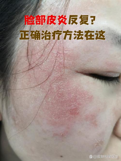 做臉會紅多久
