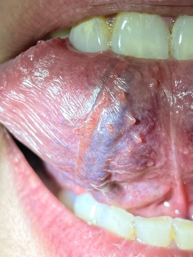 舌下一顆一顆正常嗎