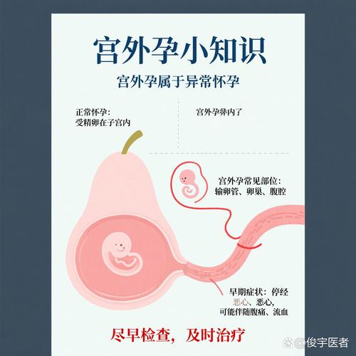 誰容易子宮外孕