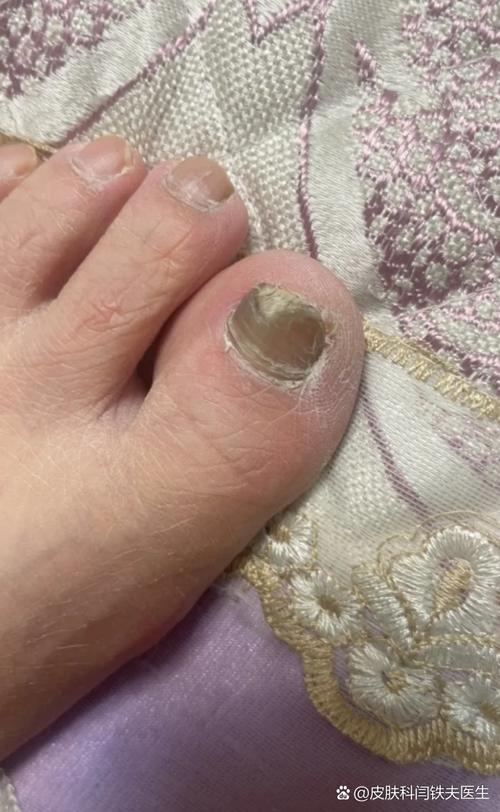 指甲變厚就是灰指甲嗎