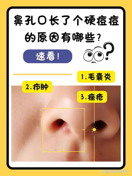 為什麼鼻子裡面一直長痘痘?深度解析與解決之道 1 為什麼鼻子裡面一直長痘痘