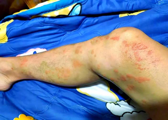 水母螫傷看什麼科?緊急處理、就醫判斷與預防全攻略 1 水母螫傷看什麼科