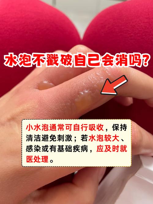 水泡會自己消嗎