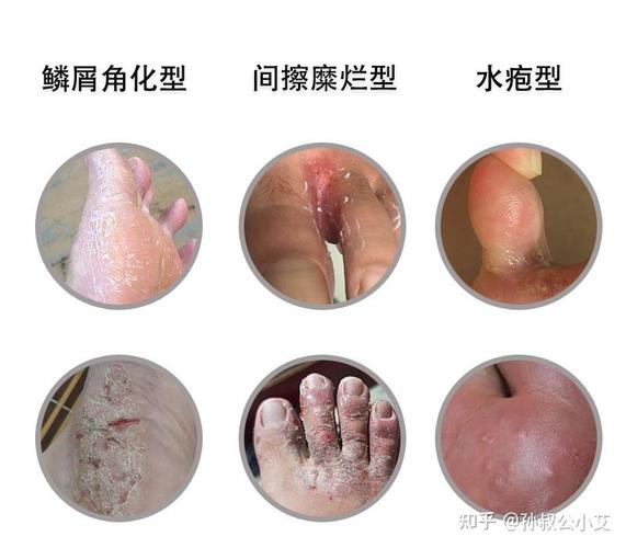 怎麼知道自己有沒有腳氣