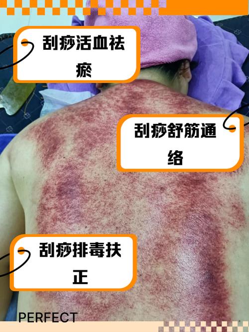 刮痧真的有用嗎