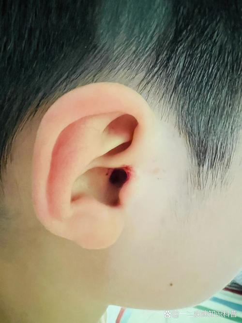 中耳炎會流血嗎