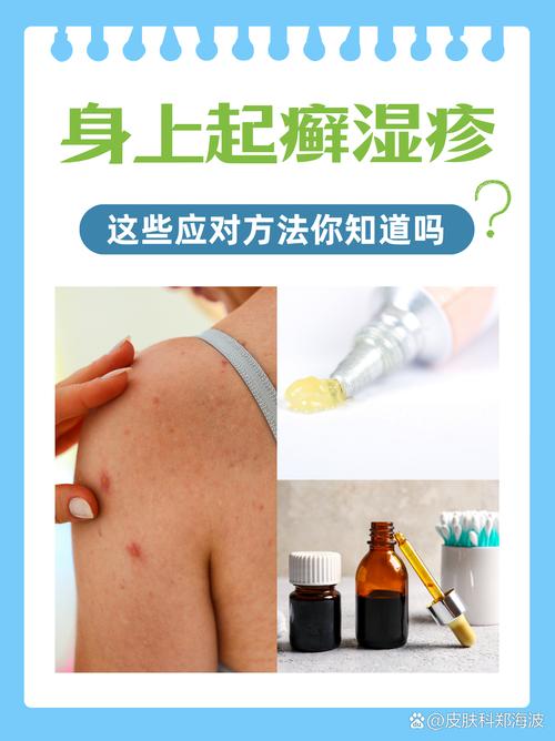 紫雲膏擦濕疹有效嗎